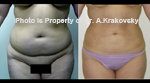 Female Abdomen liposuction