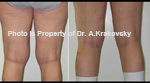 Female Knee liposuction