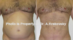 liposuction Male Abdomen liposuction