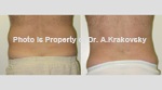 liposuction Male Flanks