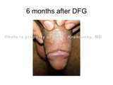 Penile Triple Augmentation Dermal Graft 6 months
